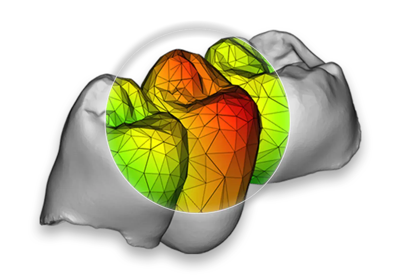 Analisi strutturale FEM di una corona su molare: la mappa di colori dal verde al rosso mostra come si distribuiscono le sollecitazioni